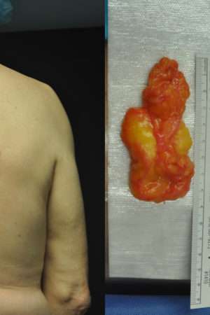 Minimal Incision and Power-assisted Liposuction Removal of Lipomas