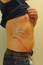 Minimal Incision and Power-assisted Liposuction Removal of Lipomas