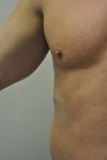 Minimal Incision and Power-assisted Liposuction Removal of Lipomas