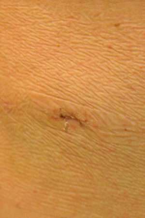 Minimal Incision and Power-assisted Liposuction Removal of Lipomas