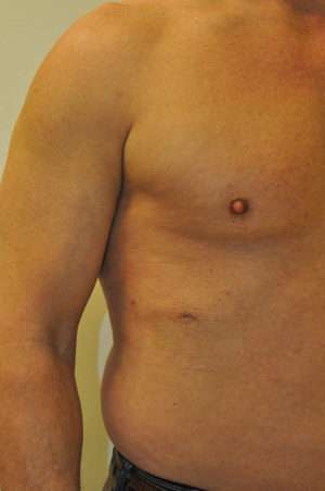 Minimal Incision and Power-assisted Liposuction Removal of Lipomas