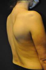 Minimal Incision and Power-assisted Liposuction Removal of Lipomas