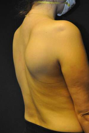 Minimal Incision and Power-assisted Liposuction Removal of Lipomas
