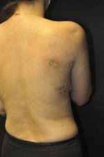 Minimal Incision and Power-assisted Liposuction Removal of Lipomas