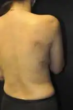 Minimal Incision and Power-assisted Liposuction Removal of Lipomas
