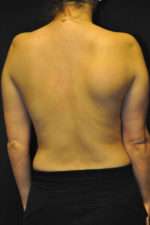 Minimal Incision and Power-assisted Liposuction Removal of Lipomas