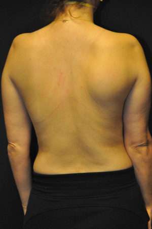 Minimal Incision and Power-assisted Liposuction Removal of Lipomas