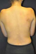 Minimal Incision and Power-assisted Liposuction Removal of Lipomas