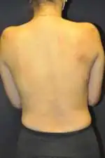 Minimal Incision and Power-assisted Liposuction Removal of Lipomas