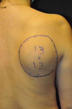 Minimal Incision and Power-assisted Liposuction Removal of Lipomas