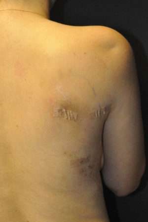 Minimal Incision and Power-assisted Liposuction Removal of Lipomas
