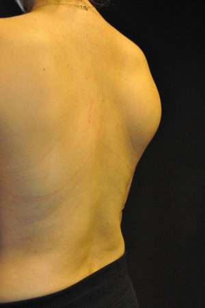 Minimal Incision and Power-assisted Liposuction Removal of Lipomas