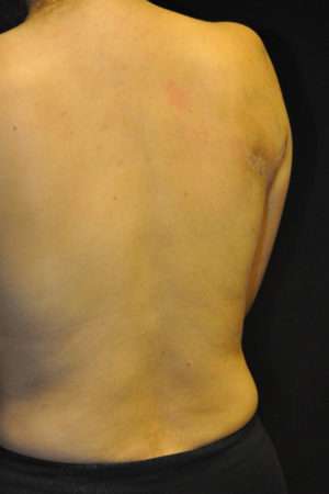 Minimal Incision and Power-assisted Liposuction Removal of Lipomas