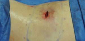 Minimal Incision and Power-assisted Liposuction Removal of Lipomas