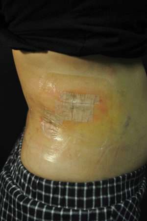 Minimal Incision and Power-assisted Liposuction Removal of Lipomas