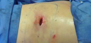 Minimal Incision and Power-assisted Liposuction Removal of Lipomas