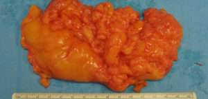 Minimal Incision and Power-assisted Liposuction Removal of Lipomas