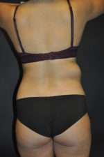Minimal Incision and Power-assisted Liposuction Removal of Lipomas