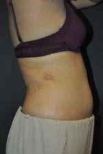 Minimal Incision and Power-assisted Liposuction Removal of Lipomas