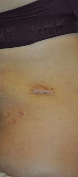 Minimal Incision and Power-assisted Liposuction Removal of Lipomas