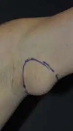 Minimal Incision and Power-assisted Liposuction Removal of Lipomas