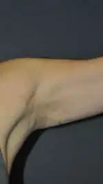 Minimal Incision and Power-assisted Liposuction Removal of Lipomas