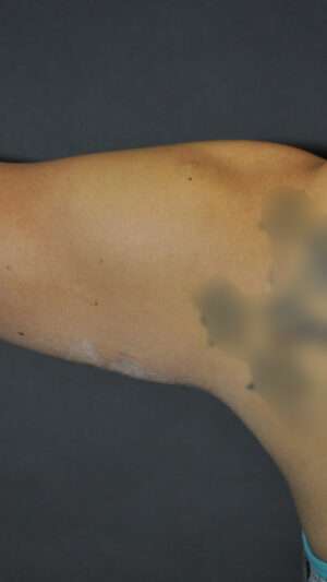 Minimal Incision and Power-assisted Liposuction Removal of Lipomas