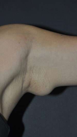 Minimal Incision and Power-assisted Liposuction Removal of Lipomas