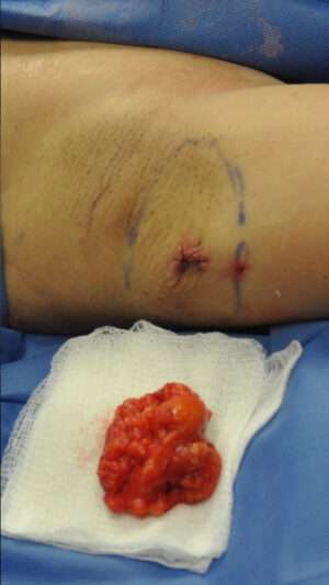Minimal Incision and Power-assisted Liposuction Removal of Lipomas
