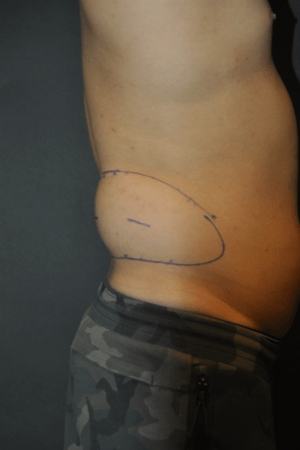 Minimal Incision and Power-assisted Liposuction Removal of Lipomas