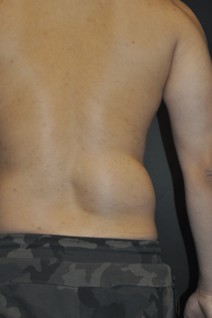 Minimal Incision and Power-assisted Liposuction Removal of Lipomas