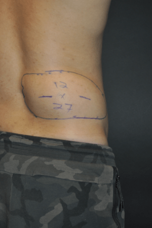 Minimal Incision and Power-assisted Liposuction Removal of Lipomas
