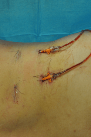Minimal Incision and Power-assisted Liposuction Removal of Lipomas
