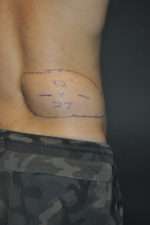Minimal Incision and Power-assisted Liposuction Removal of Lipomas