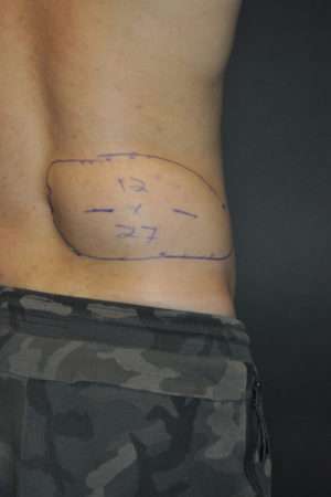 Minimal Incision and Power-assisted Liposuction Removal of Lipomas