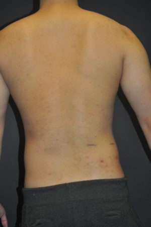 Minimal Incision and Power-assisted Liposuction Removal of Lipomas