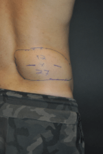 Minimal Incision and Power-assisted Liposuction Removal of Lipomas