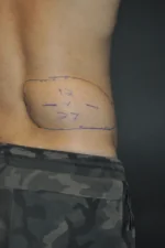 Minimal Incision and Power-assisted Liposuction Removal of Lipomas
