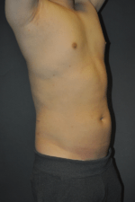Minimal Incision and Power-assisted Liposuction Removal of Lipomas