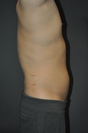 Minimal Incision and Power-assisted Liposuction Removal of Lipomas