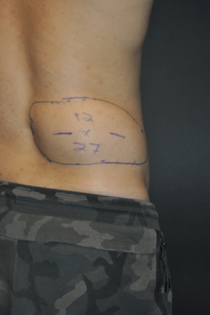 Minimal Incision and Power-assisted Liposuction Removal of Lipomas
