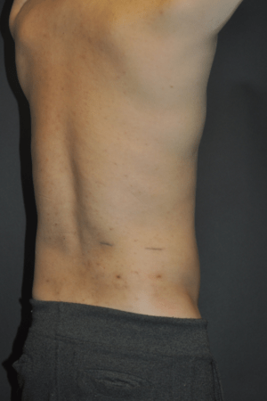 Minimal Incision and Power-assisted Liposuction Removal of Lipomas