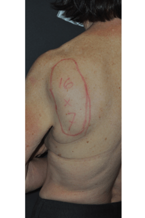 Minimal Incision and Power-assisted Liposuction Removal of Lipomas