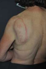 Minimal Incision and Power-assisted Liposuction Removal of Lipomas