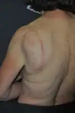 Minimal Incision and Power-assisted Liposuction Removal of Lipomas
