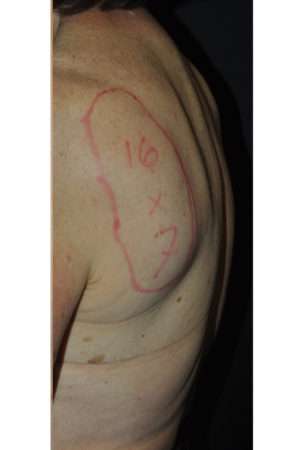 Minimal Incision and Power-assisted Liposuction Removal of Lipomas