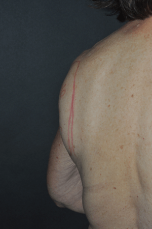 Minimal Incision and Power-assisted Liposuction Removal of Lipomas