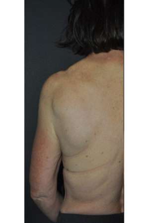 Minimal Incision and Power-assisted Liposuction Removal of Lipomas