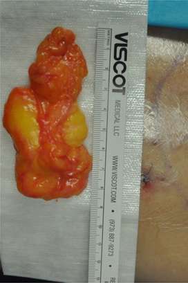 Minimal Incision and Power-assisted Liposuction Removal of Lipomas