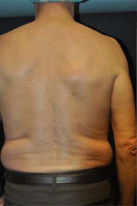 Minimal Incision and Power-assisted Liposuction Removal of Lipomas